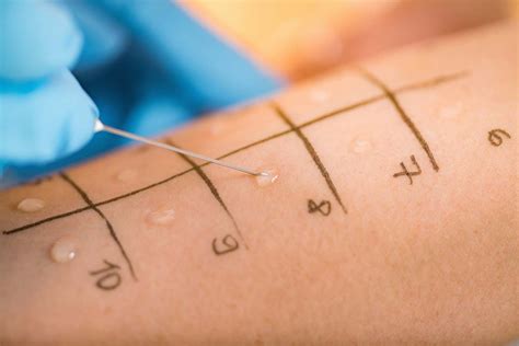 how to read allergy skin test results chart
